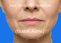 Uzun dudakların kısaltılması dudak asma yöntemi ile yapılır