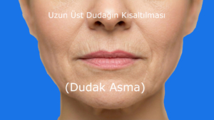 Uzun dudakların kısaltılması dudak asma yöntemi ile yapılır